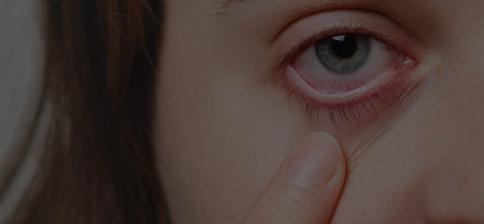 Can Pink Eye Be Diagnosed Virtually